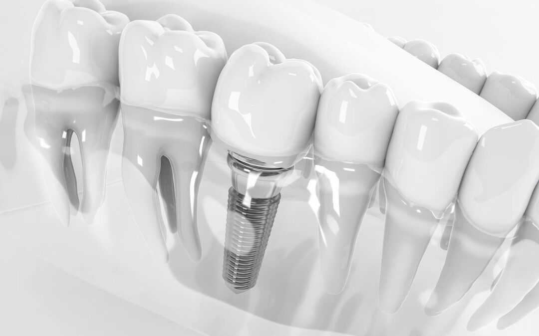 The Three Parts of a Dental Implant: Understanding the Structure of a Permanent Tooth Replacement