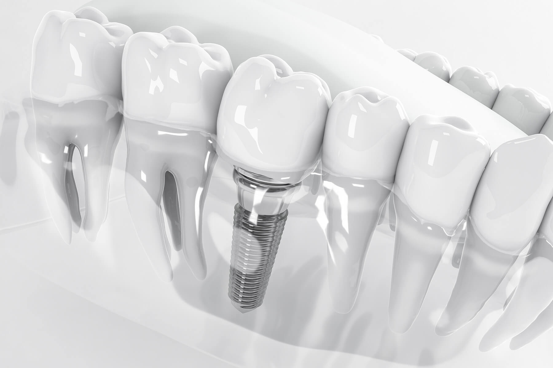The Three Parts of a Dental Implant: Understanding the Structure of a Permanent Tooth Replacement