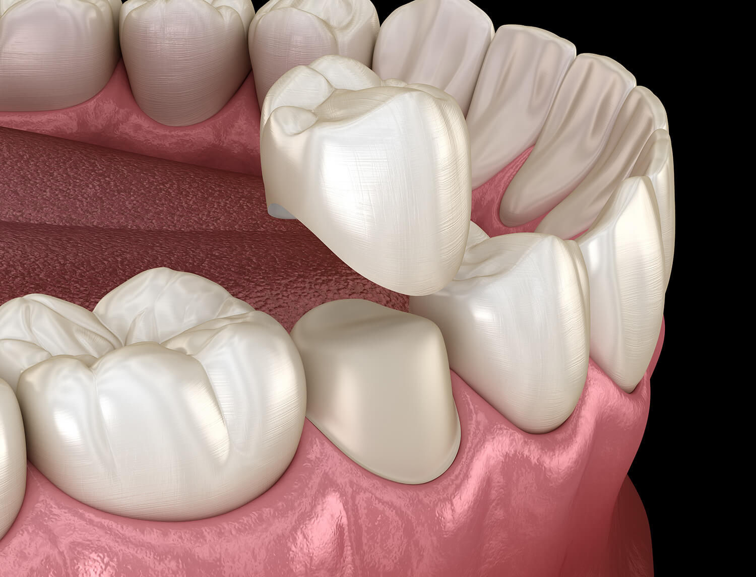 what-do-healthy-gums-look-like_1 understanding dental crown lifespan
