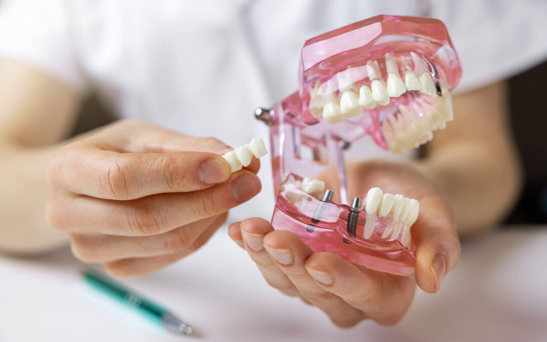 Dental Bridge vs. Implant: Which One Is Right for You?