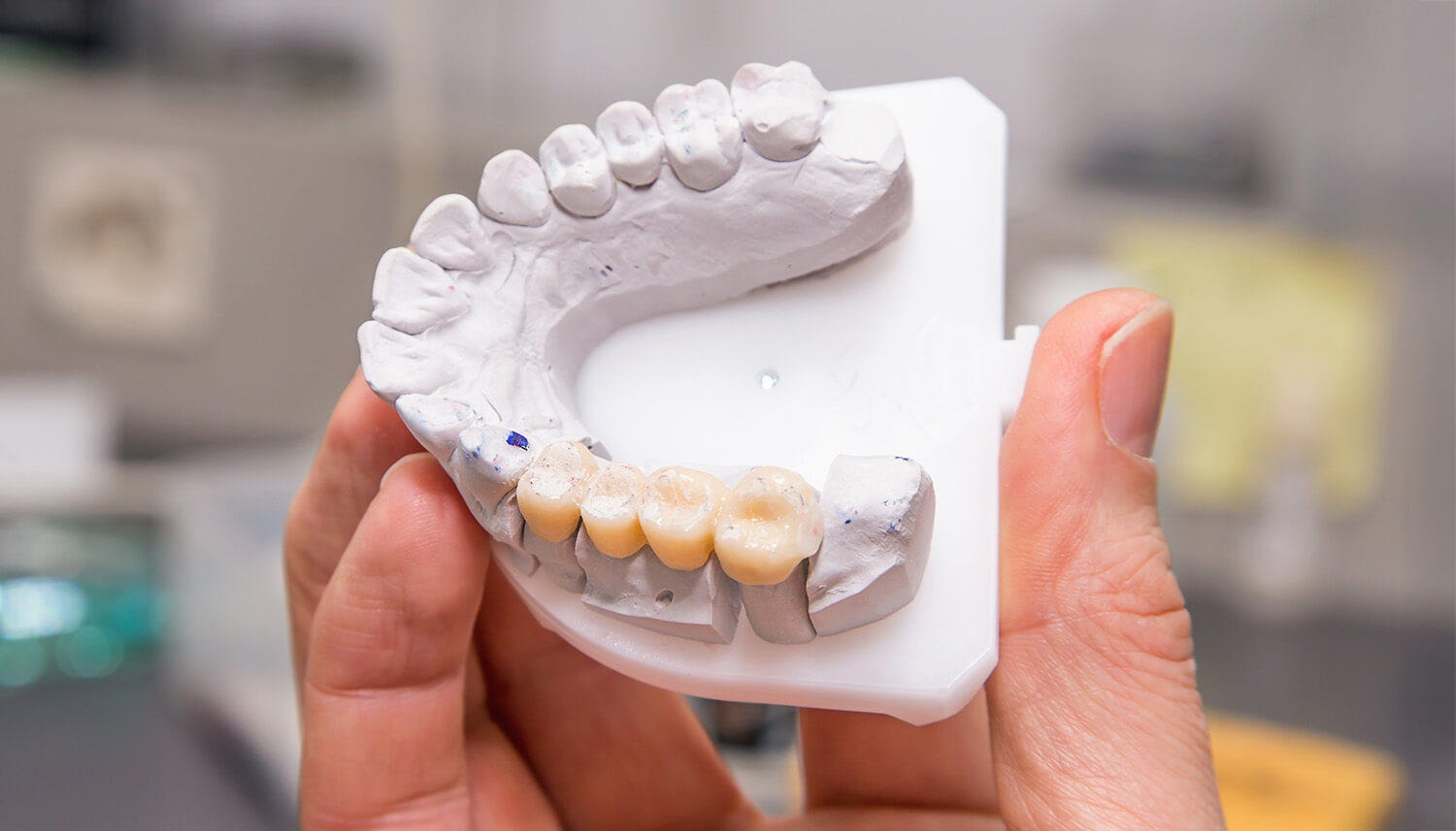 visit alora dental today for your dental bridge or dental implant