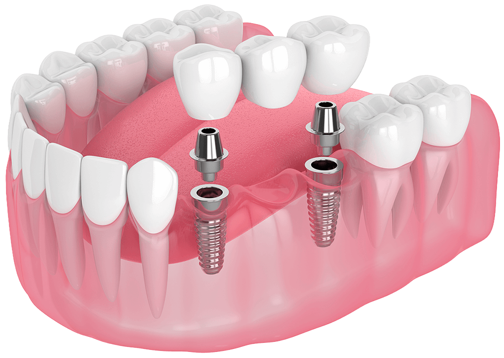 what is a dental implant