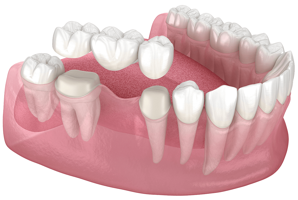 what is a dental bridge